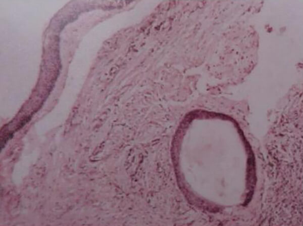 Figura 3. Imagen histopatológica. Epitelio plano estratificado. Estroma inflamado. Islotes de epitelio similar al epitelio de revestimiento. “Quistes hijas”.