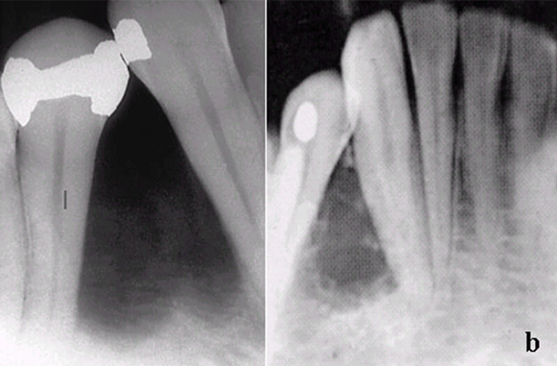 Figura 4 - Diagnóstico diferencial: a = TOE; b = Ameloblastoma unicistico