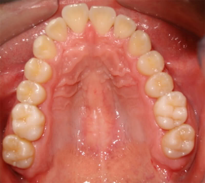 Figura Nº8. Control post-operatoria 6 meses. Vista oclusal