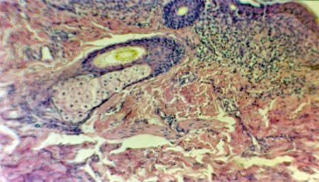 FIG. 1.- Cortes histológicos de muestra de cuero cabelludo. Hematoxilina eosina.