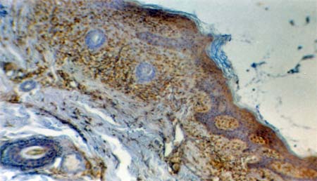 FIG. 2.- Inmunohistoquímica. Positividad a S-100 en lesión de cuero cabelludo.