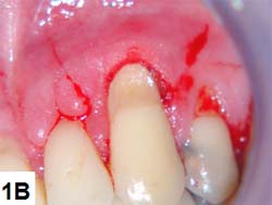 B) incisión oblicua en mesial y en distal, sin abarcar la papila.