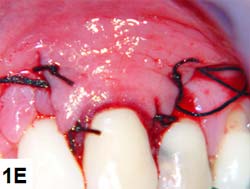 E) colocación y fijación del tejido a través de puntos aislados con un hilo de nylon 5.0.
