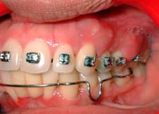 Figura 2: Absceso Periodontal en la zona del 1er. molar maxilar izquierdo en paciente joven femenina que asiste a consulta