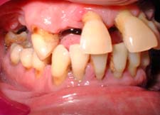 Figura 4: Absceso Periodontal en la zona de incisivo central maxilar relacionado con Periodontitis Crónica en paciente adulto que asiste a consulta