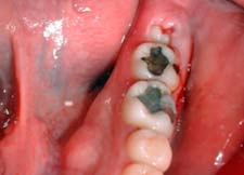 Figura 6: Absceso Pericoronario en la zona del 3er. molar mandibular izquierdo en paciente joven que asiste a consulta