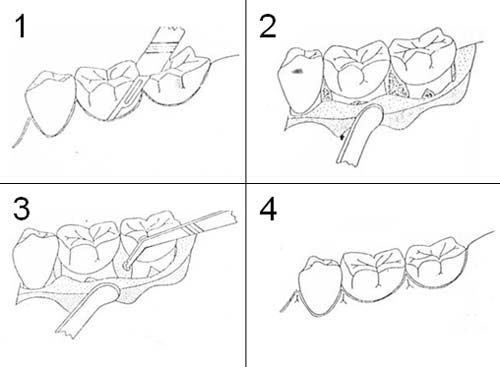 Figura 7: Técnica recomendada por Dafi S. Quteish Taani (102) . 1) Incisión realizada en el surco relativo a la lesión, 2) Colgajo de grosor total levantado exponiéndose la lesión tras la irrigación. 3) Acondicionamiento de la zona con la aplicación de una torunda de algodón empapada en suspensión de Doxiciclina. 4) Sutura con seda discontinua.
