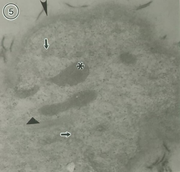Figura 5 En esta micrografía electrónica: flechas: vesículas; rombo: miofilamentos; asterísco: mitocondrias; cabeza de flecha: membrana basal engrosada. Aumento: 30.000.
