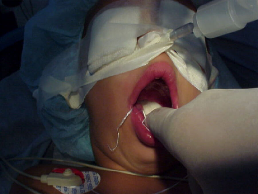 Intubación nasal - colocación de Packing