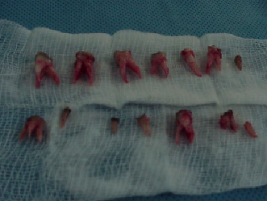 Dientes extraídos