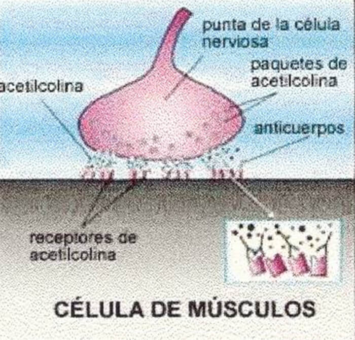 Fig. 1. Normalmente la acetilcolina fluye del nervio al músculo para causar una contracción muscular. En la MG los anticuerpos atacan los receptores (sitios de estacionamiento) para acetilcolina, causando debilidad muscular