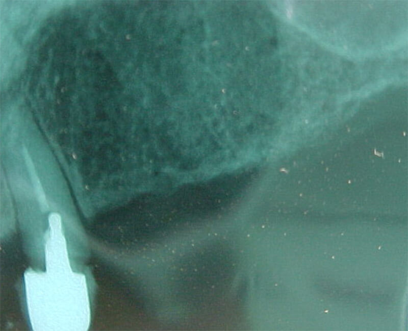 Fig. 2 Diente 22: imagen radiográfica.