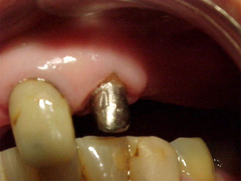 Fig. 3 Diente a extraer