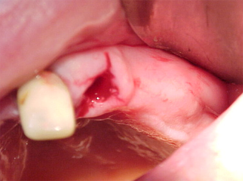 Fig. 4 Alvéolo dentario correspondiente al incisivo lateral superior izquierdo después de la exodoncia simple.