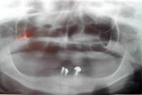 Fig.1. Radiografía panorámica. Obsérvese reabsorción marcada del reborde residual inferior desde la zona de premolares.