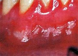 Figura 4: Estomatitis aftosa recidivante tipo herpetiforme en vestibular en el sector anteroinferior (61)