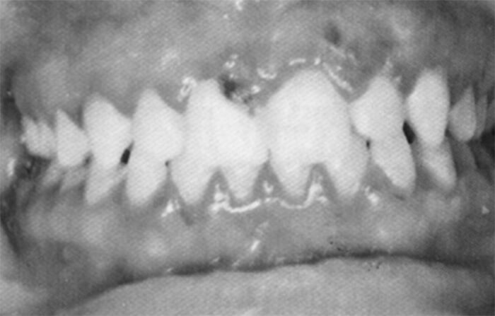 Figura 3: Gingivoestomatitis herpetica primaria: vesículas en la encia. 7