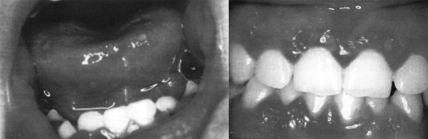 Figura 4: Gingivoestomatitis herpetica primaria: multiples lesiones vesiculoerosivas en mucosa y labios en una gingivitis permanente. 53
