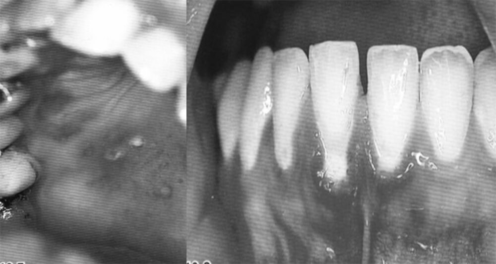 Figura 6: las formas recurrentes de gingivoestomatitis herpética primaria en adultos a menudo son confundidas con aftas. En la mucosa palatina son visibles las vesículas individuales. La “asimetría” de la gingivitis en los dientes anteriores mandibulares excluye el diagnostico de inflamación por placa. 53-55