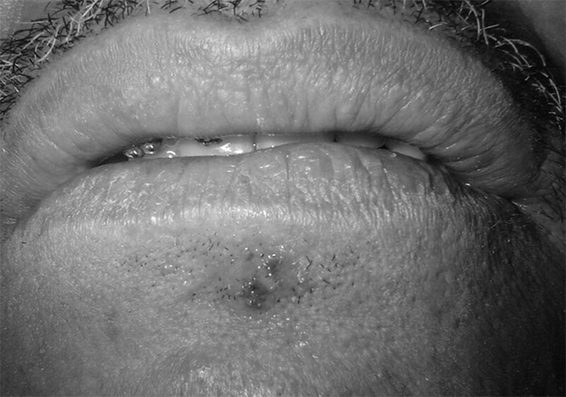 Figura 9: lesión de herpes simple ubicada debajo del labio inferior en paciente adulto masculino que asiste a consulta