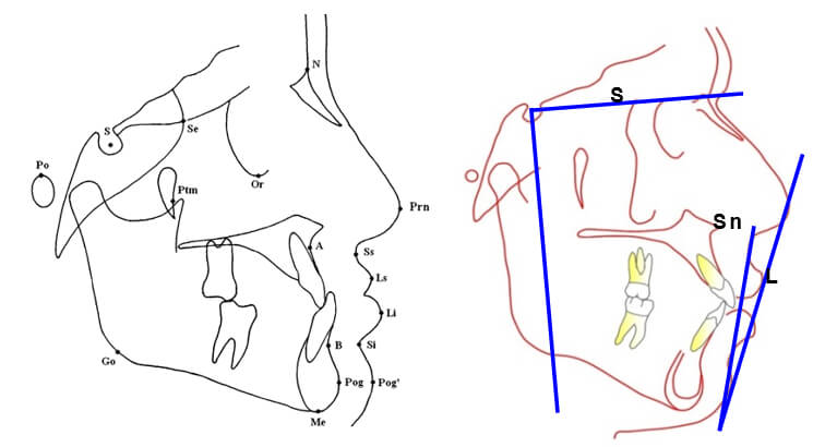 Fig.2. Puntos, líneas y planos de referencia cefalométricos. Línea E Labio superior, labio inferior. Línea SnPg´ Labiosuperior, Labio inferior, SN-VS