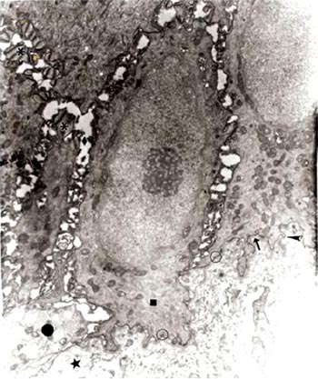 Fig. 2 En esta sección de la muestra se puede apreciar que la membrana basal luce contínua (↑) aún cuando existen algunas áreas de discontínuidad (▲). Se puede observar pocas vesículas pinocíticas y caveólas (○) Algunos agregados de filamentos de keratina (■). Melanocito (●), colágeno en cantidad variable (¤), y separación de desmosomas (*). Barra: 1µm.