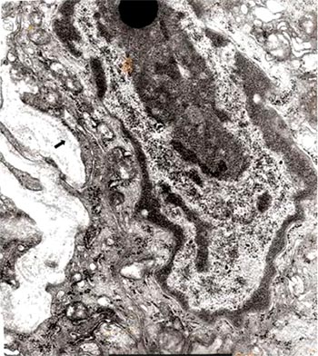 Fig. 3 En esta sección se observa la membrana basal engrosada (↑), extensas áreas sin hemidesmosomas y otras con desmosomas inexistentes Barra: 2µm.
