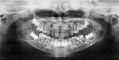 Fig. 6 Lesiones oste ooliticas en mandibula (Flecha), erupcion prematura de 26 y ausencia de los germenes del 35 y 45. Radiografia panoramica inicial