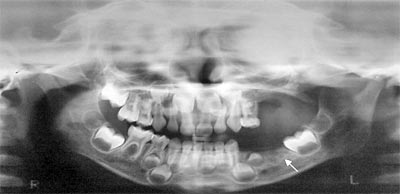 Fig. 7 Zonas de reosificacion (Flechas). Radigrafia panoramica de control despues de dos meses de la intervencion quirurgica