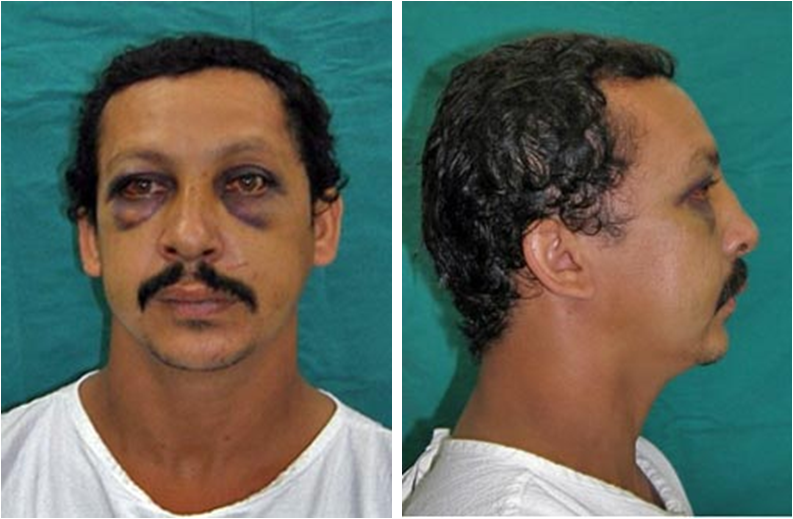 Figura 1 A y B: Imagen pre-operatoria de Frente y perfil donde se observa edema y equimosis periorbitaria bilateral, equimosis subconjuntival bilateral, y edema en dorso nasal