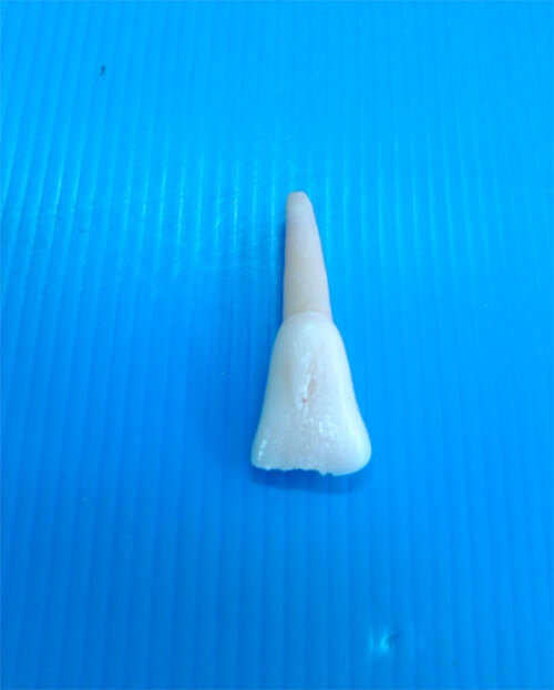 Figura 1. Incisivo bovino, cara Vestibular