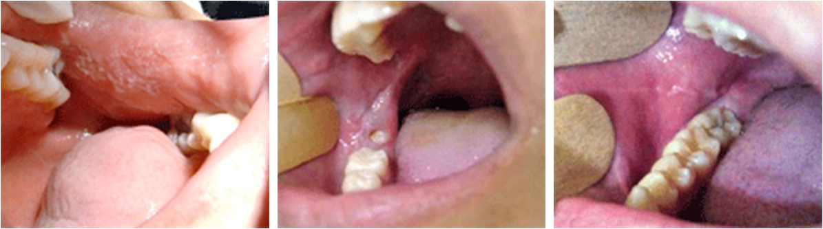 Morsiscatum Buccarum Fuente Propia