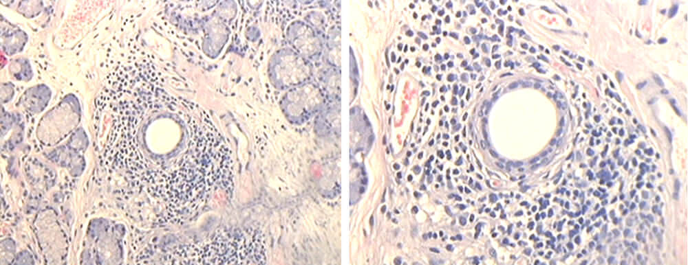 Fig. 2 Biopsia de glándulas salivales accesorias de labio inferior Grado II en pacientes con Síndrome de Sjögren Fig. 2 Biopsia de glándulas salivales accesorias de labio inferior. Grado III Grado III: sialoadenitis crónica severa con 50 o más linfocitos por campo