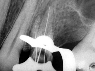 Fig. IX: Comprobación radiográfica de la longitud de trabajo.