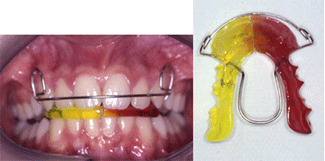 Fig. 2 (a,b): Activador de Andresen