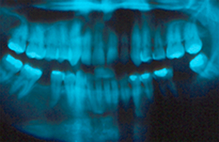 Figura 3. Radiografía panorámica