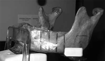 Figura 1 Dispositivo diseñado para la ubicación de las mandíbulas en el equipo de tomografía espiral convencional Cranex Torne multifunctional unit (Soredex, Helsinki, Finlandia). También se observa las láminas de plomo dispuestas en el cuerpo mandibular indicando los cuatro sectores evaluados.