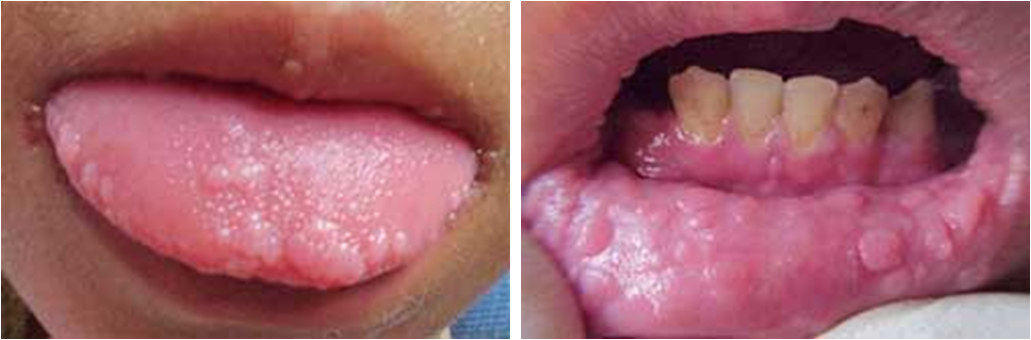 Fig. 1 y 2 Lesiones de HEM en mucosa lingual y labial