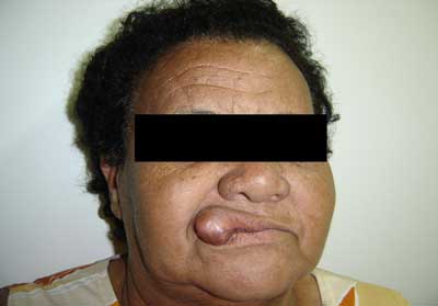 Figura 1 Aspecto extra - oral de lesión nodular acerca de 4 cm en labio superior.