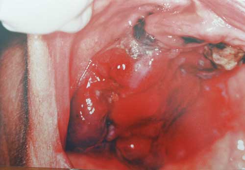 Foto 1 Melanoma en reborde y paladar duro; extensión superficial hacia la mitad derecha