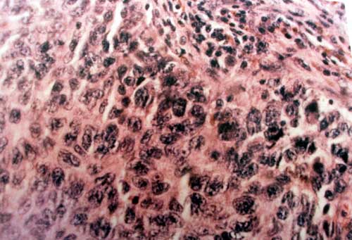 Foto 2 Histopatología: Proliferación de células neoplásicas fusiformes y epitelioides
