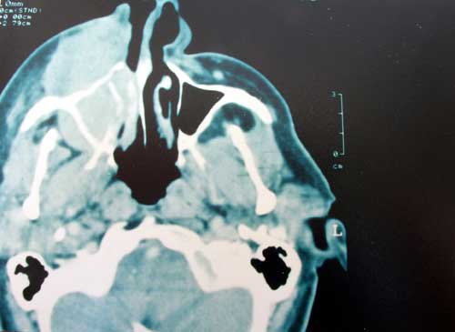 Foto 3 TAC: Desplazamiento y obliteración de los tejidos faciales