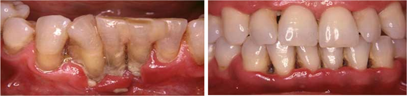 Manifestaciones Clínicas de GUN y su degeneración a Periodontitis Ulcero Necrosante (PUN).