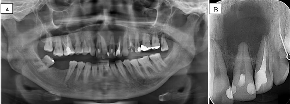 Figura 1 (A) Radiografía panorámica que muestra una lesión en los órganos dentarios 21 y 22; (B) Radiografía periapical que muestra la lesión apical en dientes 21 y 22