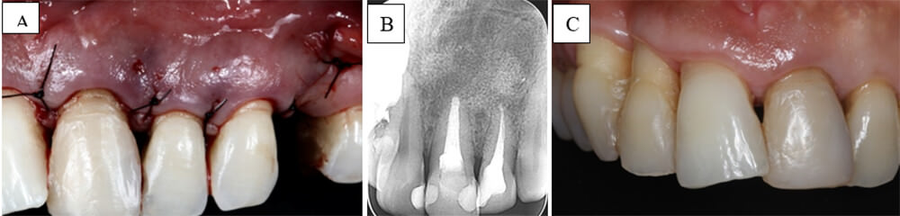 Figura 3 (A) Sutura con nylon 5.0; (B) Control radiográfico después de 7 meses; (C) Foto clínica 7 meses después.