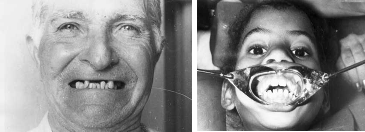 Fig.2 y 3 Severa Limitación de la apertura bucal debida a anquilosis tmporomandibular bilateral
