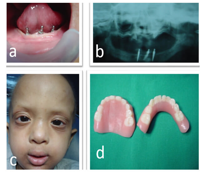 Fig 3. Fotografías Pos-operatorias al mes a) implantes en zona anterior, b) radiografía panorámica mostrando los implantes colocados c) aspecto facial del paciente, d) dentaduras ya confeccionadas