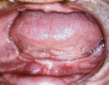 Figura 1 Reborde alveolar mandibular atrófico