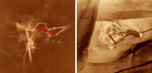 Fig.3 Disección de las carótidas primitivas y externa Arteriografía carotídea externa. Fase de llene arterial