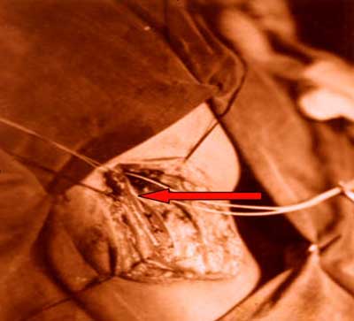 Fig. 4 Ligadura de la arteria carótida externa